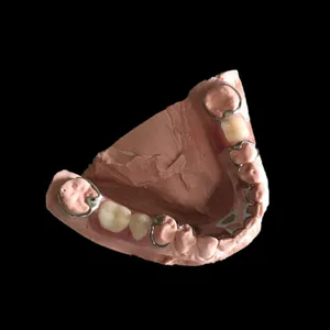 Cast partial – case by Well Dental Lab