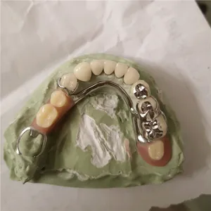Cast partial with crown – case by Well Dental Lab