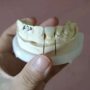 Emax crown – case by Well Dental Lab