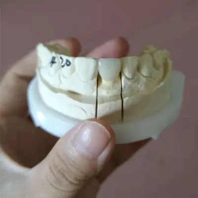 Emax crown – case by Well Dental Lab