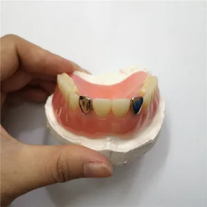 Gold crown on denture – case by Well Dental Lab