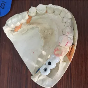 Zirconia implant bridge – case by Well Dental Lab