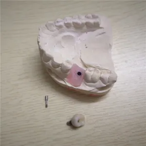 Implant crown – case by Well Dental Lab (2)