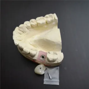 Full zirconia implant crown – case by Well Dental Lab