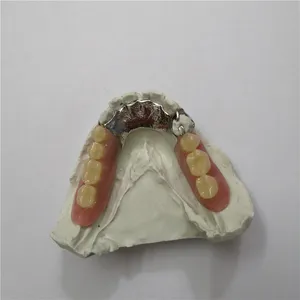 Metal denture – case by Well Dental Lab