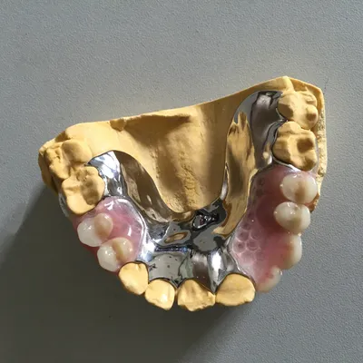 Metal framework – case by Well Dental Lab