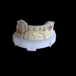 PFM and metal framework – case by Well Dental Lab