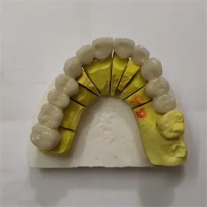 Pfm bridge – case by Well Dental Lab